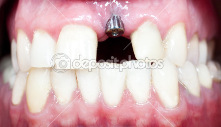 depositphotos_23913507-dental-implant
